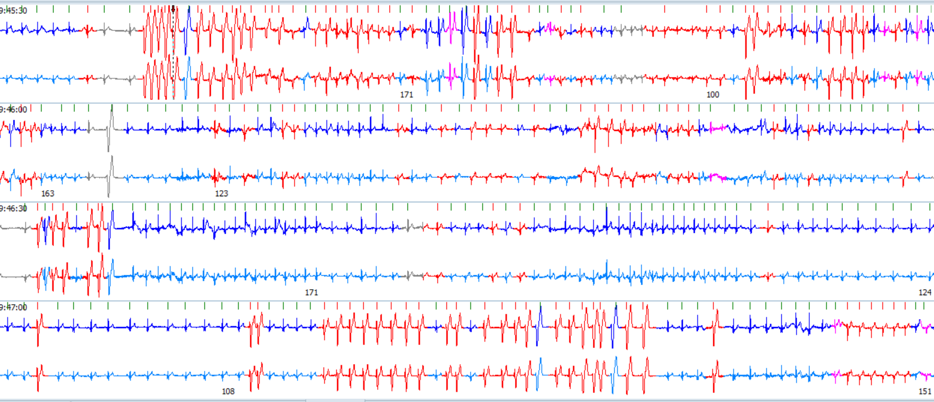Holter-trace med ventrikulär takykardi och r-on-t